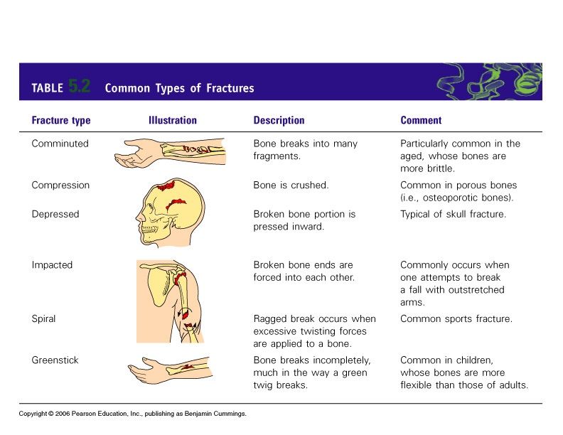 Writing Realisitic Injuries--Broken Bones | Books & Writing Amino