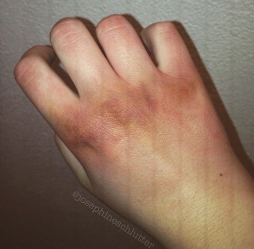 Bruised knuckles Special Effects Makeup Amino.