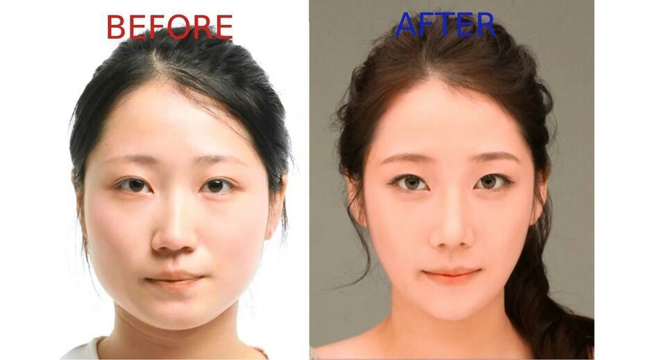 plastic-surgery-in-korea-k-pop-amino