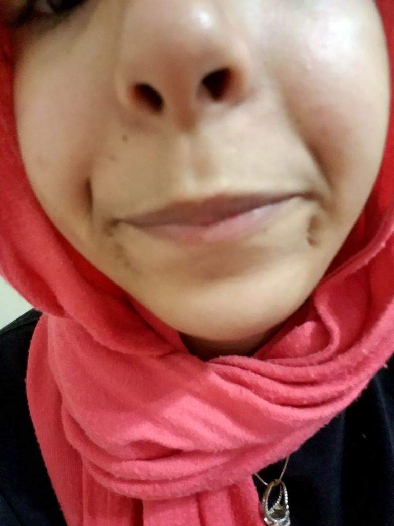 Why Do I Have So Many Dimples