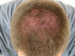 yeast infection scalp hair