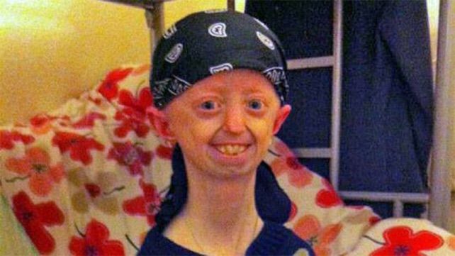 Progeria: Children die due to 