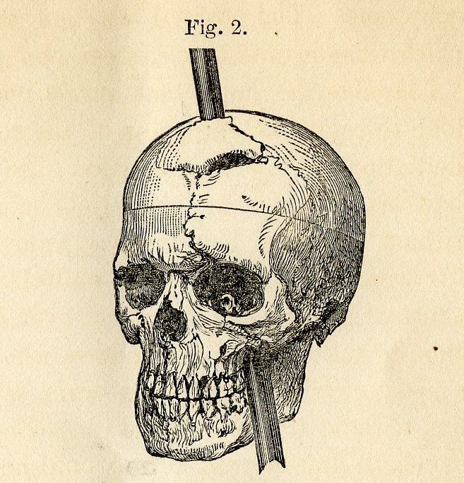 The Miracle of Phineas Gage.