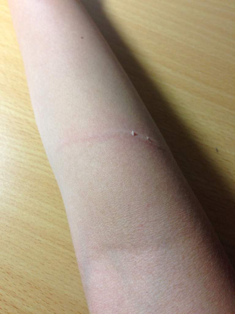 Neighbour's dog scratched me | Dogs Amino