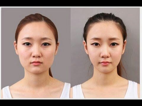 korean eye widening surgery