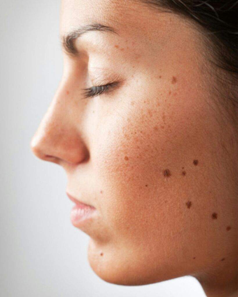 Moles on the face Moles on the face
