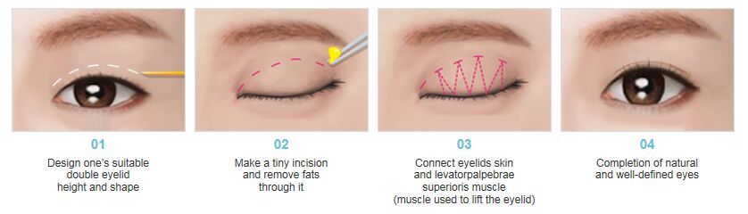 kpop double eyelid surgery