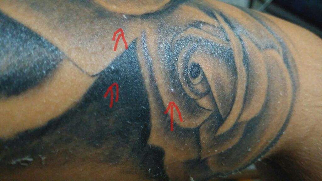 Pimple Like Bumps On Tattoo