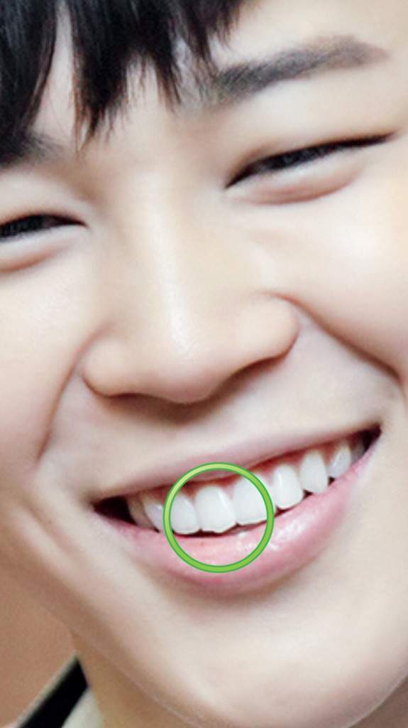 Poll: Suga's Hairline or Jimin's Chipped Tooth? | K-Pop Amino