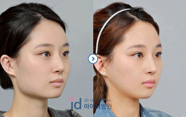 Plastic Surgery In Korea KPop Amino