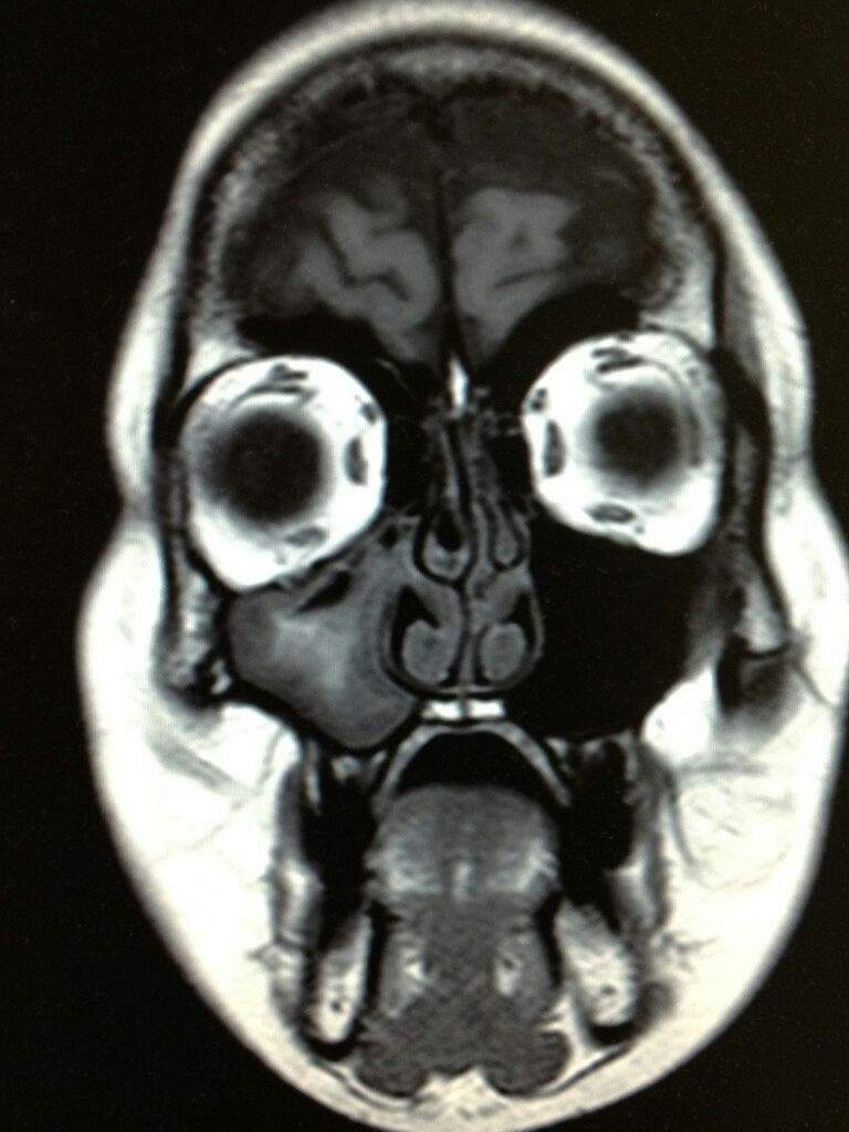 MRI face scans Horror Amino