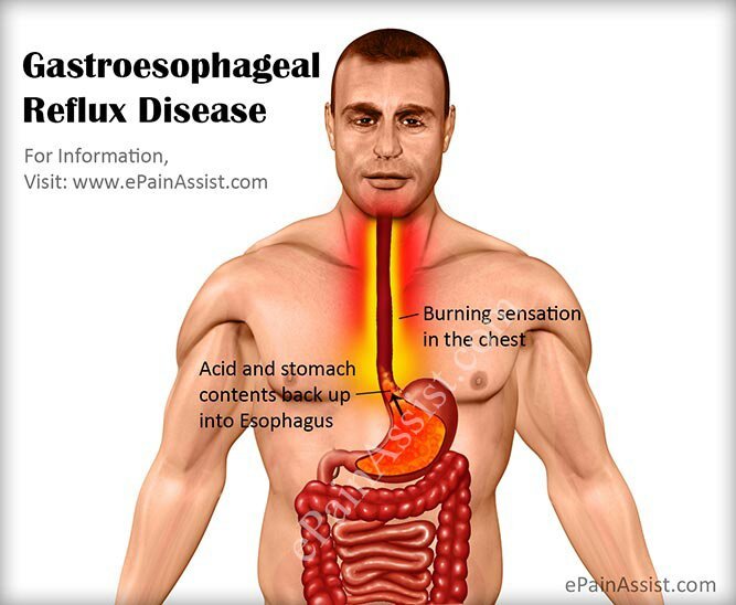 gastroesophageal-reflux-disease-gerd-medical-nutritional-therapy