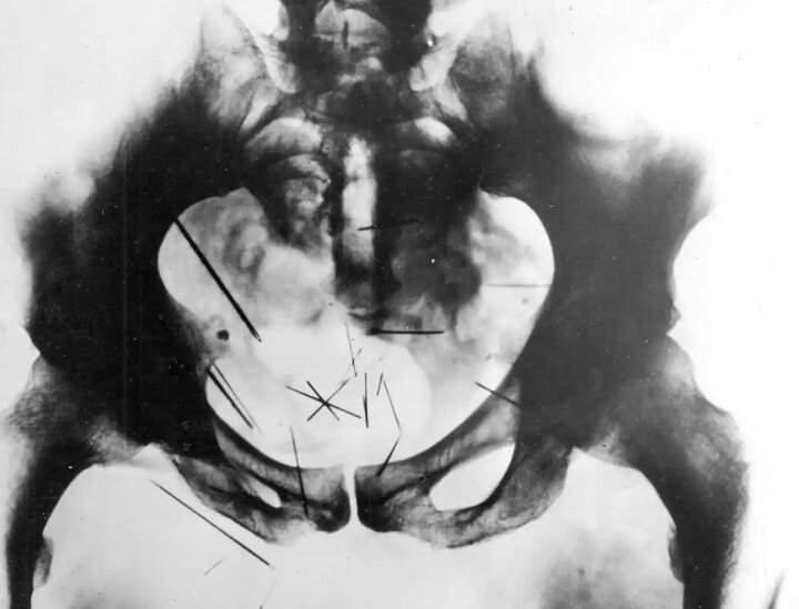 Radiografía de la pelvis postmortem, en donde se ven las agujas incrustadas en su carne