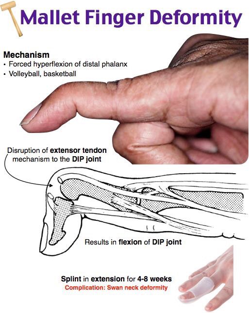 what-i-learned-today-hand-deformities-medical-amino