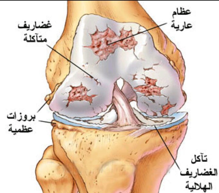 ما علاج احتكاك الركبة علاج آلام المفاصل بالأعشاب خطوات معبرة Amino