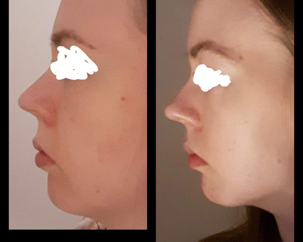 nose subliminal results nose subliminal results