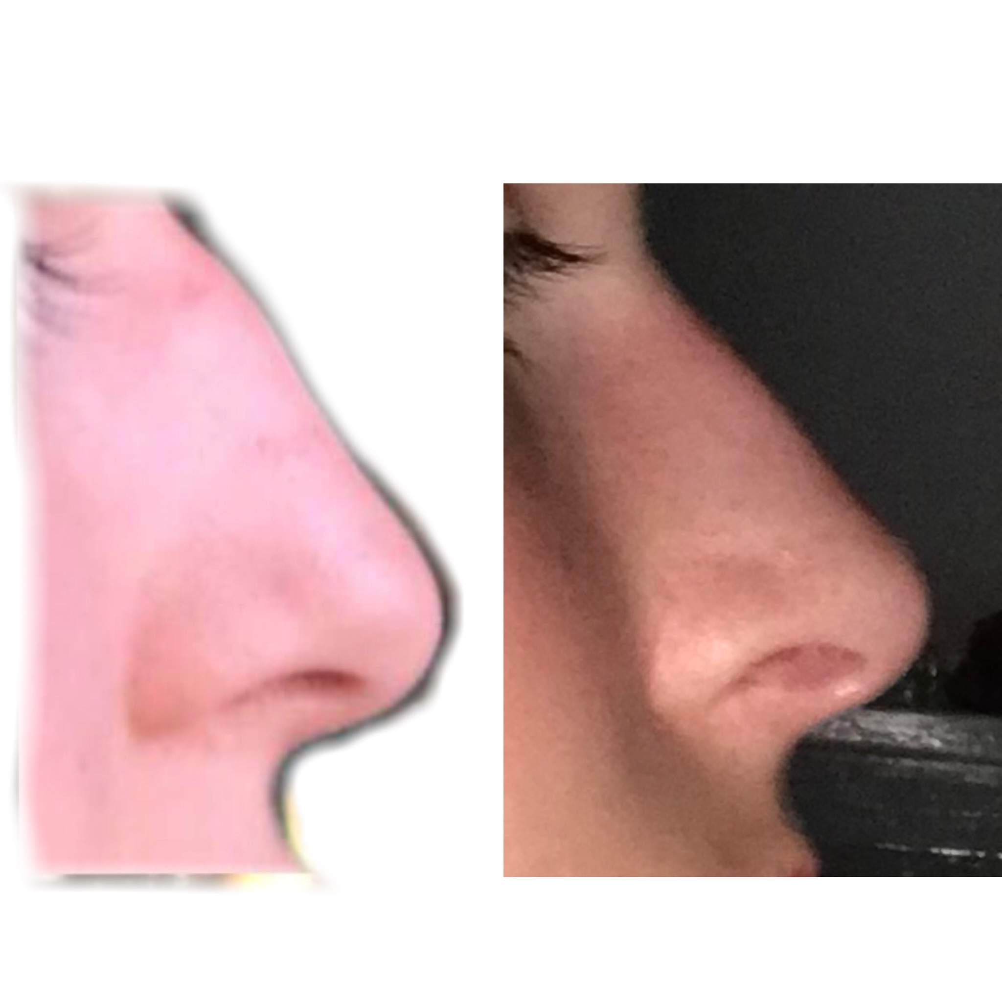 Nose results | Subliminal Users Amino