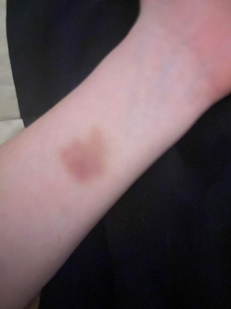 Burn that Looks like a Bruise? | Dating 🌹 Amino